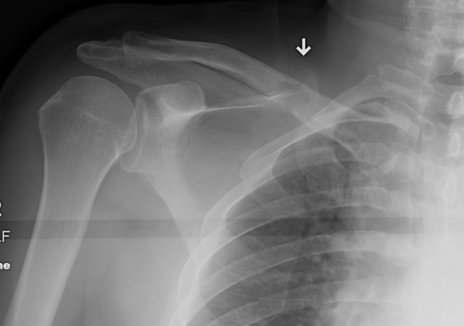 Clavicle Metastasis